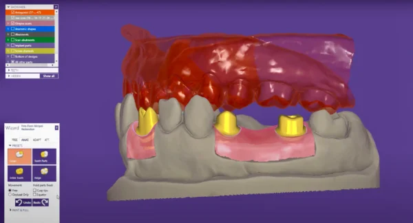 Custom Abutments - Image 2